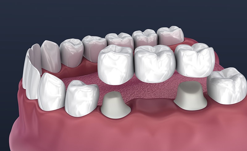 Dental Bridges in NW Calgary