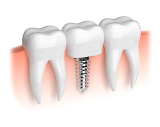 Dental Implants in NW Calgary