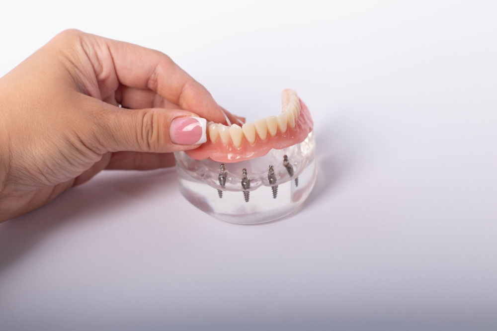 What Are the Benefits of an All-On-4 Implant