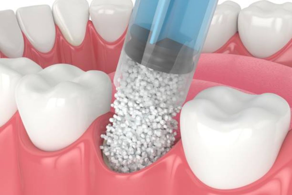 Bone graft procedure for dental implant support
