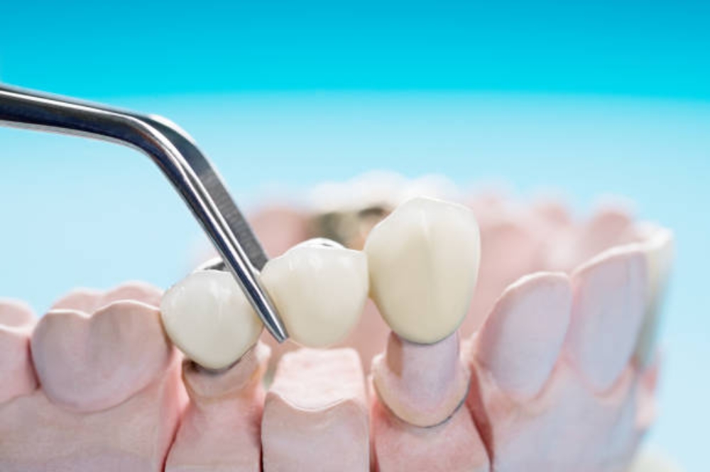The Complete Guide to Dental Bridges: Benefits, Process, and Aftercare