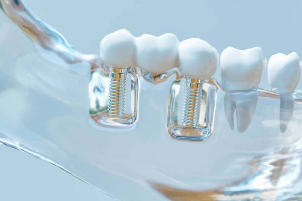Dental Implants Explained: Procedure, Benefits & Long-Term Results