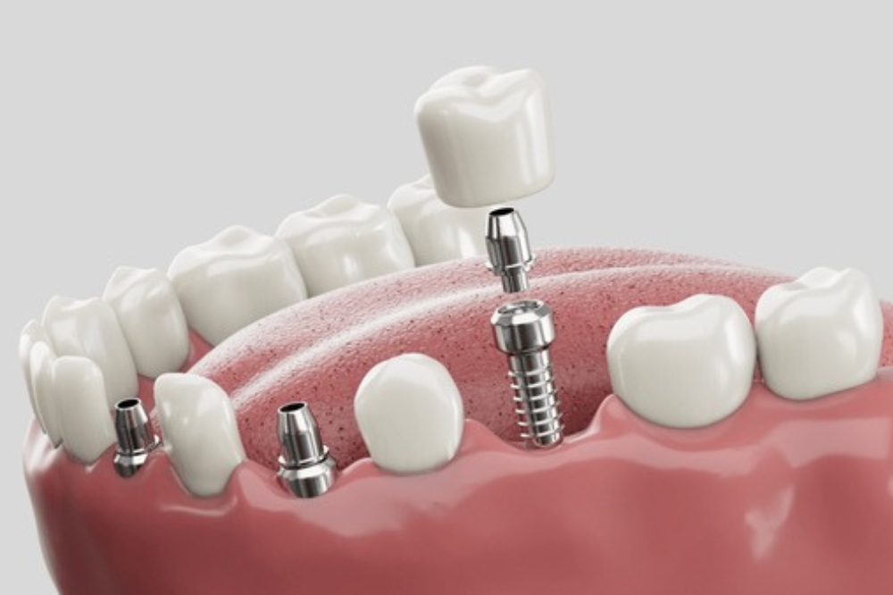 Are Dental Implants Right for You? Key Factors to Consider